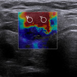 Càncer de tiroide - malalties de la tiroide